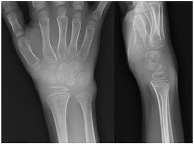 Childhood Polyarthritis As Early Manifestation of Autoimmune Polyendocrinopathy with Candidiasis and Ectodermal Dystrophy Syndrome